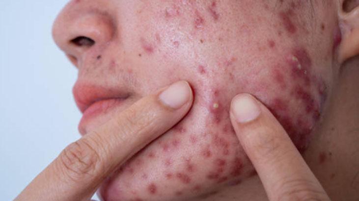 İrin akan sivilcelerinden kurtuldu Çözümü çok basit: İçeriği bu asitle dolu