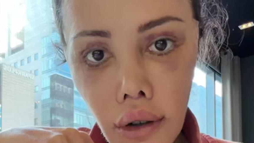 Eski Survivor yarışmacısının inanılmaz değişimi: ‘Yüz naklimin 16. günü’ deyip paylaştı