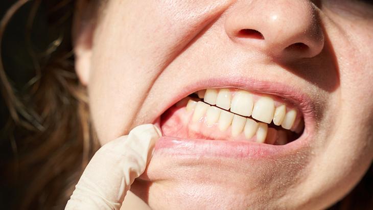 ‘Diş eti hastalıkları kalp ve damar sağlığını olumsuz etkiliyor’