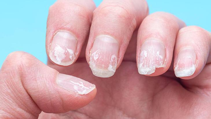 Saç dökülmesinin kahramanı yumurtaymış Sofralarda gizlenen biotin deposu