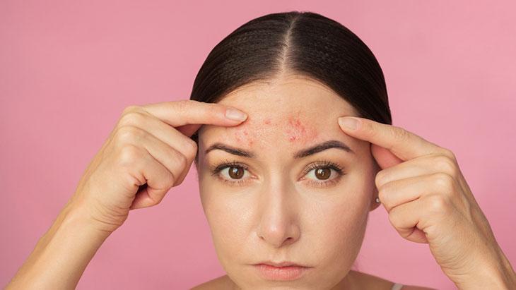 “Hormonal aknede kalıcı çözüm, kişiye özel dermatolojik değerlendirmedir” “Hormonal aknede kalıcı çözüm, kişiye özel dermatolojik değerlendirmedir”