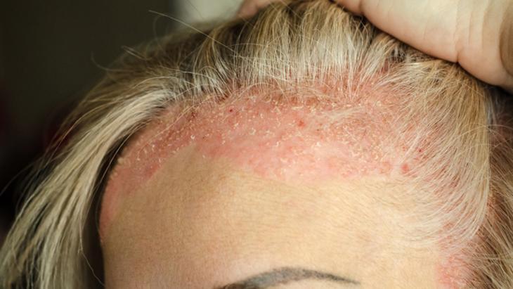 EGZAMANIN EN SIK GÖRÜLEN NEDENLERİ