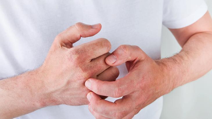 Meğer egzamanın başlangıcı böyleymiş Kaşıntıyı önemseyin