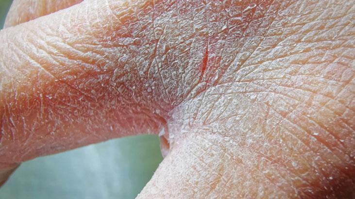 Kuru soğuktan kurtaran formül Ellerinizi neme doyuracak, çatlama derdine son