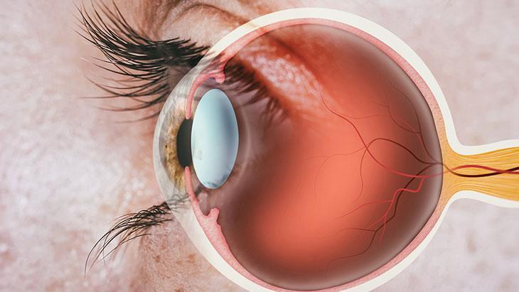 Kalıcı görme kaybına neden olabilir