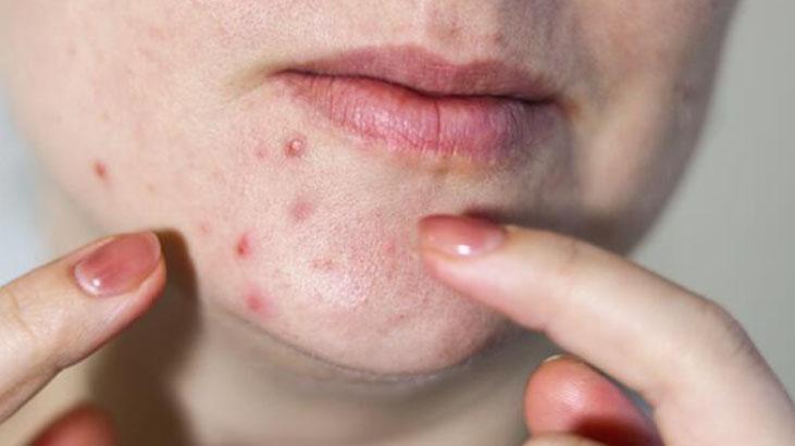 Sirkeyle sivilce temizleme yöntemi gerçekten faydalı mı Güvenli formül böyleymiş