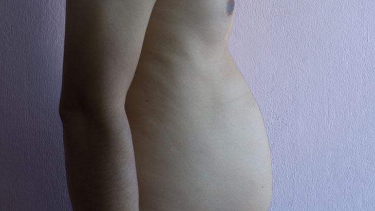 Bağırsak delinmesi ve hayati riske yol açabiliyor