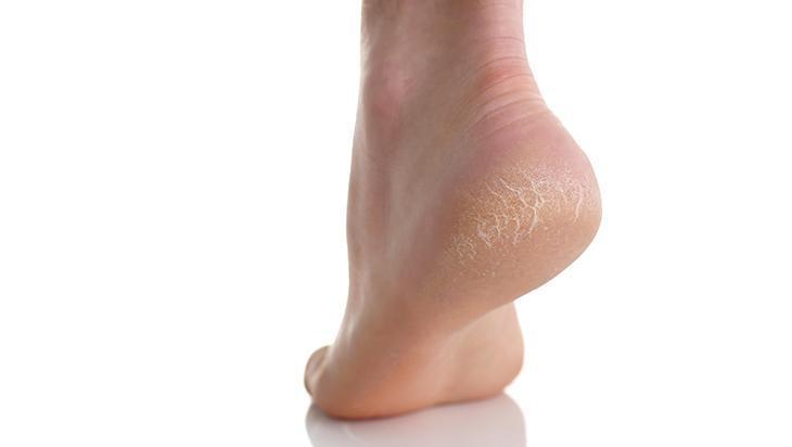 Topukları bebek gibi yapıyor Çatlamış ayaklara birebir doğal çözüm