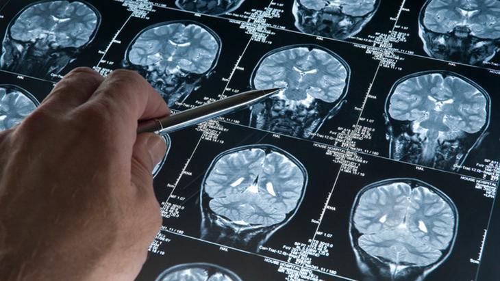 Alzheimera karşı yeni umut Zinde hafızanın sırrı mutfakta saklı