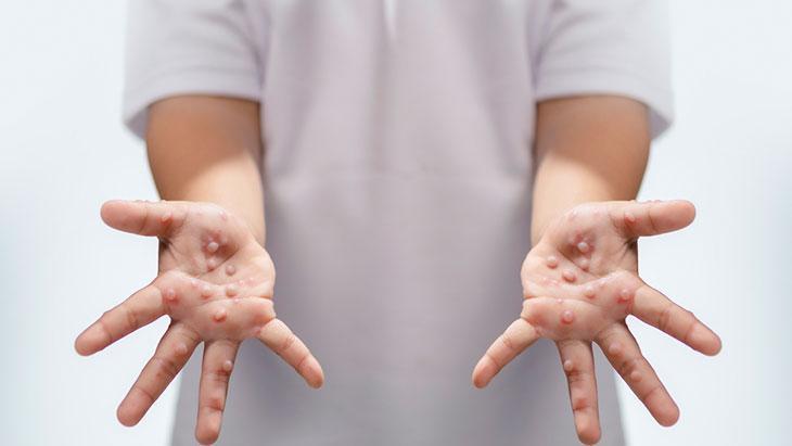 Çocuklarda hızla bulaşıyor! Ağız yaraları ve döküntülerle geliyor: Hafife almayın