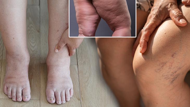 Kilo değil hastalık! Bu hatalar bacaklarda dolaşımı bozuyor