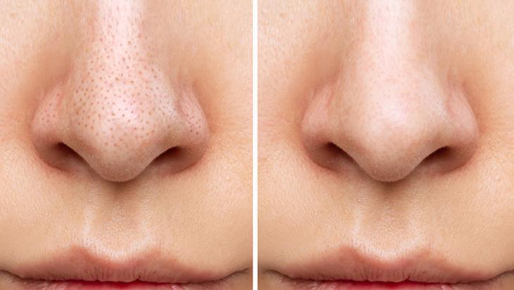 Siyah noktalara birebir Üstelik sadece 2 malzemeyle doğal peeling