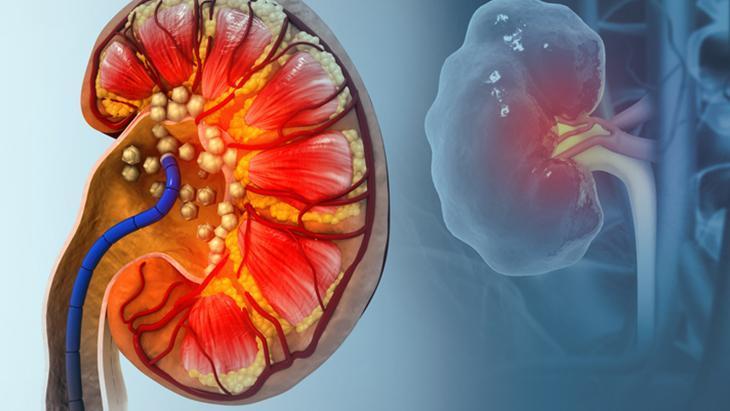 Damak tadınız böbreklerinizi küstürmesin Günlük limit sadece 1 gram