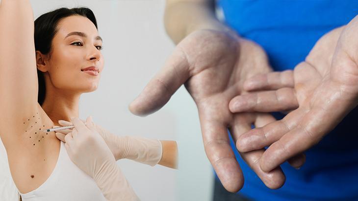 Özgüveni düşürüyor! Terlemenin çözümü botoks mu, cerrahi mi?