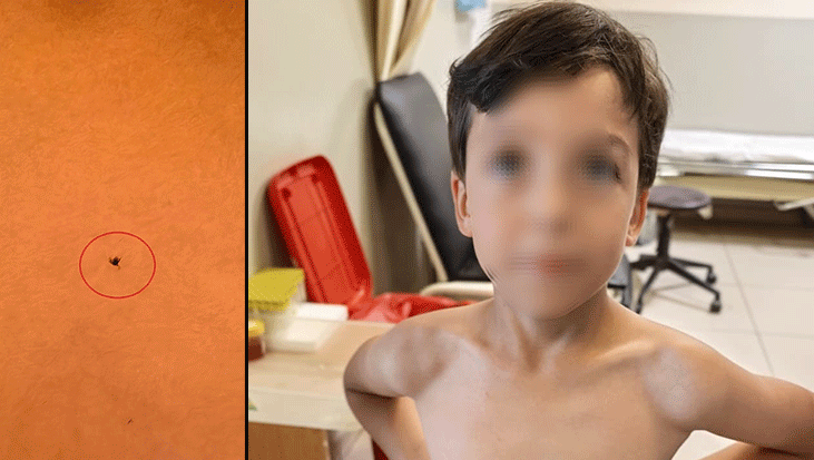 Oyun oynarken fark etti! 7 yaşındaki çocuğun göğsüne kene yapıştı