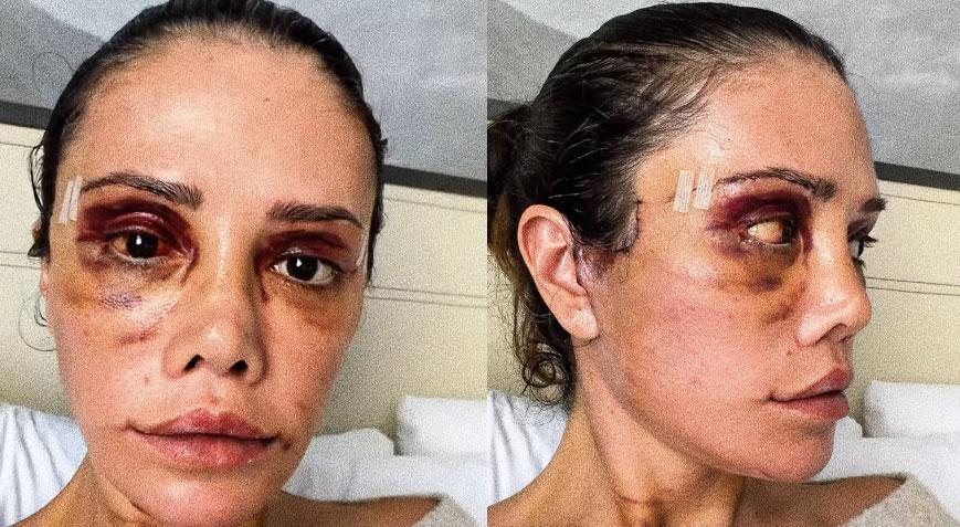 İki kez yüzünü gerdirdi Didem Ceran’dan yeni estetik açıklaması
