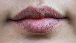 Kış aylarının can yakan sorunu! 1 damlası yetiyor, dudakları pamuk gibi yapıyor