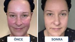 Öbek öbek çıkıyordu! Cilt kızarıklığı için tek hamle: '2 hafta bu serumu sürdüm'