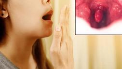 Dış fırçalamaya rağmen geçmeyen ağız kokusunun nedeni: Bademcik taşları