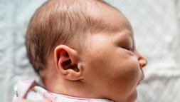 Kepçe kulak, özgüven sorunlarına yol açıyor! Ameliyatsız da tedavisi mümkün