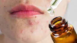 Hangi bitkiler sivilceleri tedavi edip geçirme gücüne sahip?