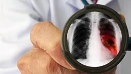 Erken evre akciğer kanserinde yüz güldüren yöntem! İyileşme süresini kısaltıyor