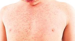 İstanbul’da kızamık tehlikesi: Aşı yaptırın