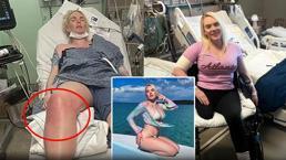 Et yiyen bakteri kabusu! İlaç verip eve gönderdikleri kadının bacağı kesildi