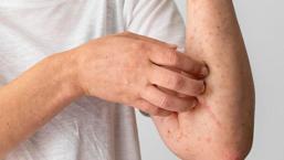 Çorap, kemer gibi vücudu sıkan noktalarda gelişiyor! Gereksiz diyet kurdeşeni tetikliyor