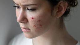 Yüzünüzdeki her sivilcenin bir anlamı var! Bu sırrı çözenler tamamen kurtuluyor