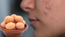 Sarısı da beyazı da sivilceleri besliyor! Gerginliğinizin sebebi yumurta olabilir