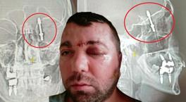 Amerikan dergilerine konu olan Türk! Beyne saplanan vida