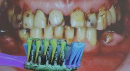 Tedavi ettiği vakalardan &ccedil;arpıcı fotoğraf paylaştı! 6 kişilik aile aynı diş fır&ccedil;asını kullandı