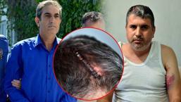 Miras yüzünden yeğenini beyzbol sopasıyla darbeden dayıdan şok sözler: Beni tahrik etti, dayanamadım