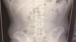 Midelerinden uyuşturucu çıktı: İranlı 3 kişi tutuklandı