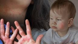 Türkiye de listede, tüm hayatı kötü etkiliyor! 'Sıradan alerji' değil: 'Kaşıdıkça çoğalır'