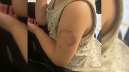 Edirne'de akılalmaz olay! Öğretmen, 3 yaşındaki çocuğu ısırdı: Öperken oldu