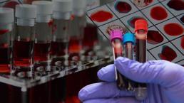 Dünyada sadece 50 kişide var! 'Altın kan' laboratuvarda üretilebilecek mi?