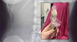 Yoğurt yerken bir anda oldu, söylemeye dahi utandı! Tam 17 santimetre büyüklüğünde, 2 gün vücudunda kaldı