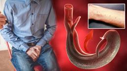 Yeni küresel tehdit: Melez şiştozomiyaz! Cinsel organlara yerleşip kısırlığa yol açıyor