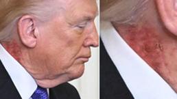 Trump’ın boynundaki kızarıklık hakkında doktorundan açıklama