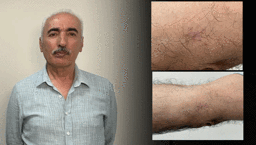 Kolundaki 1 santimetrelik yara aylarca geçmedi! Hastanede gerçeği öğrenince şoke oldu