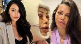 Didem Ceran 15 saatlik operasyonla yüz nakli olmuştu! Kendisini dünyaca ünlü yıldızla karşılaştırdı