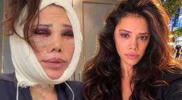 İki kez yüzünü gerdirdi! Didem Ceran’dan yeni estetik açıklaması