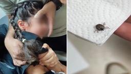 Bir aydır kulak ağrısı çekiyordu! Kulağında canlı kene bulundu