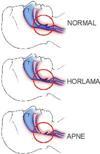 Horlama  deyip geçmeyin