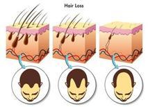 Saç Oto Klonlama Nedir? Saç Botoksu Nedir?  Saç Dolgusu Nedir?  İşe Yarar mı?
