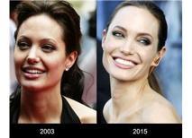 Neştersiz Estetikle Angelina Jolie Gülüşü