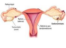 Endometriozis (Çikolata Kisti) Tedavisi