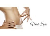 Vaser Liposuction veya Vaser Lipo Nedir?